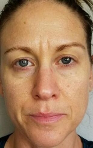 A la edad de 40 años, aparecieron arrugas profundas y manchas de edad